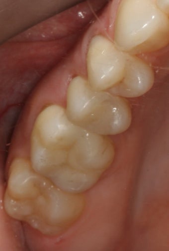 Porcelain Fillings (Inlays and Onlays)