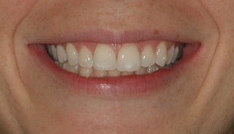 Invisalign
