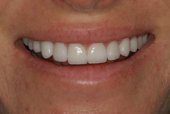 Porcelain Veneers