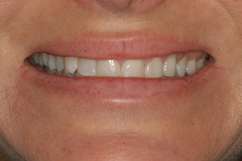 Porcelain Veneers