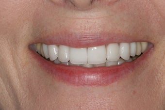Porcelain Veneers