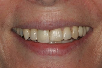 Porcelain Veneers