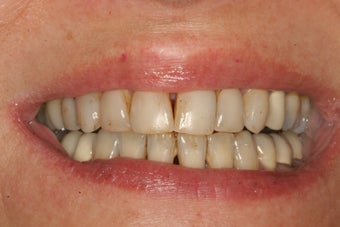 Porcelain Veneers