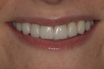 Porcelain Veneers