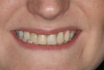 Porcelain Veneers