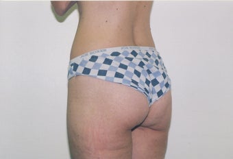 Bodylift
