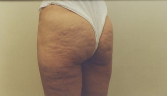 Bodylift