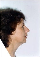 Rhinoplasty