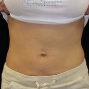 Thermage Abdomen