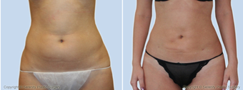 Liposuction 