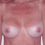 Breast Augmentation