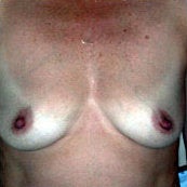 Breast Augmentation