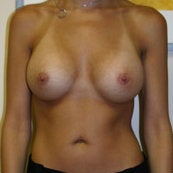 Breast Augmentation