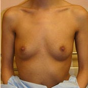 Breast Augmentation