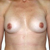 Breast Augmentation