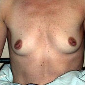 Breast Augmentation