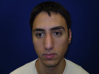 Rhinoplasty
