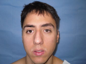 Rhinoplasty
