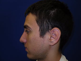 Rhinoplasty
