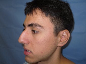 Rhinoplasty