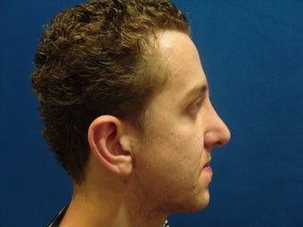 Rhinoplasty