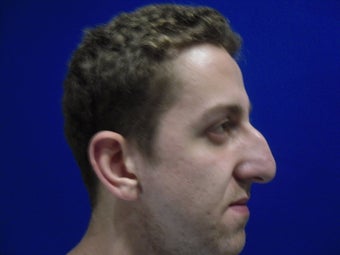 Rhinoplasty
