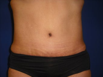 Tummy Tuck