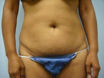 Tummy Tuck