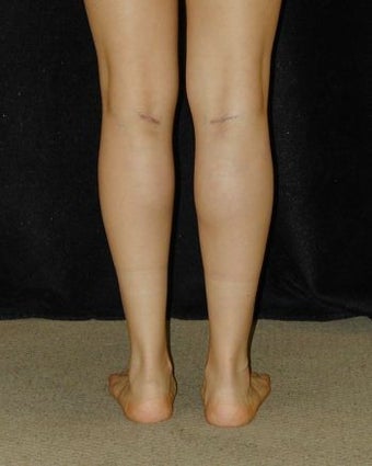 Calve Implants - Posterior View