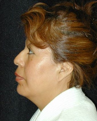 Liposuction of Chin