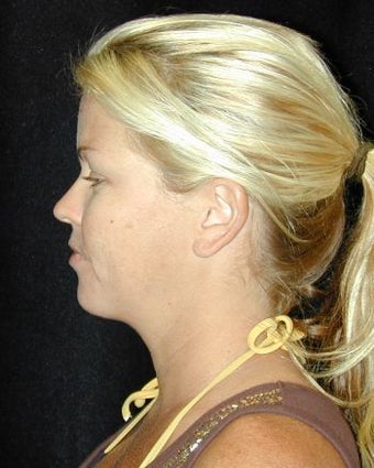 Liposuction of the Chin