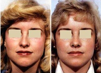 Rhinoplasty