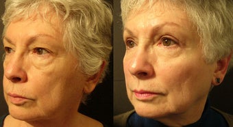 Mid Facelift