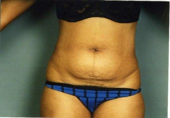 Mini Tummy Tuck