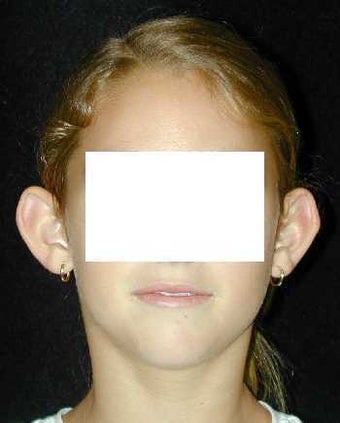 Otoplasty - Ear Surgery