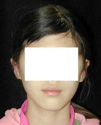 Otoplasty - Ear Surgery