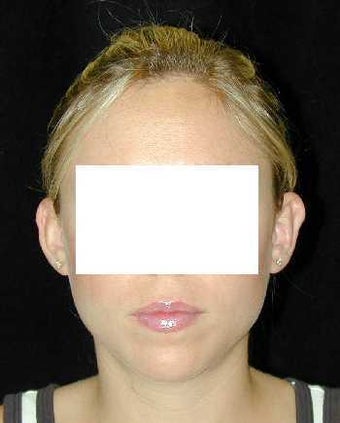 Otoplasty - Ear Surgery