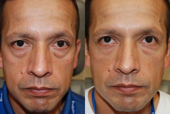 Lower eyelid and cheek rejuvenation with Silikon-1000