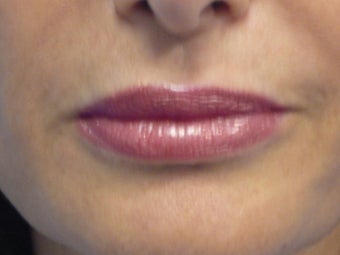 Juvederm Lips