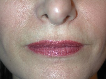 Juvederm Lips