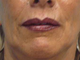 Juvederm Nasolabial folds and Lips