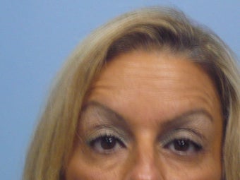 Dysport Forehead