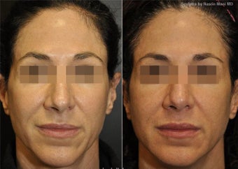 Sculptra
