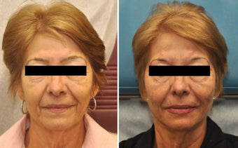 Restylane and Perlane used to volumize the entire face. 