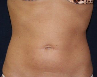 Smart Water Lipo