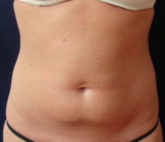Smart Water Lipo