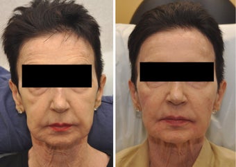 Cheek Augmentation