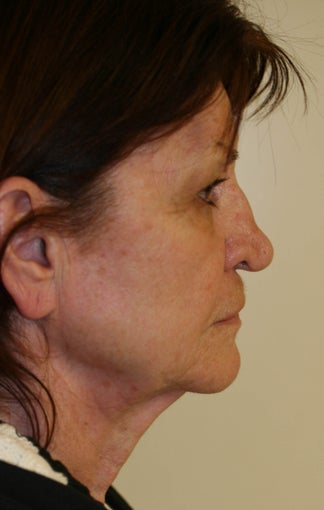 Facelift and Rhinoplasty