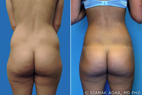 Brazilian Butt Lift