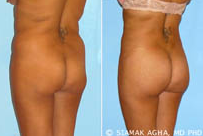 Brazilian Butt Lift